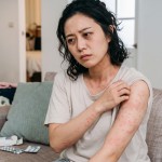 蕁麻疹
